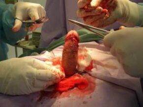operace zvětšení penisu